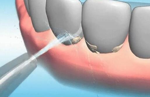洗牙多少钱-315防伪