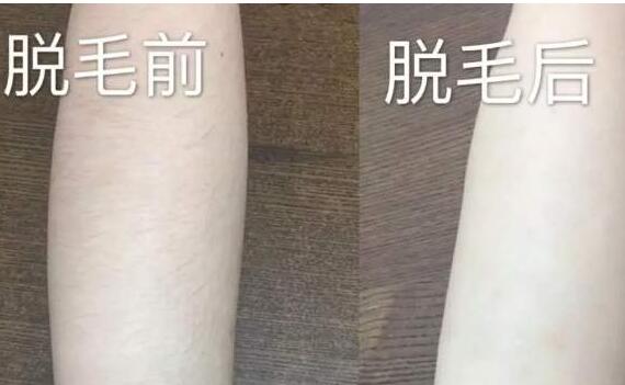 冰点脱毛怎么样-315防伪口碑网